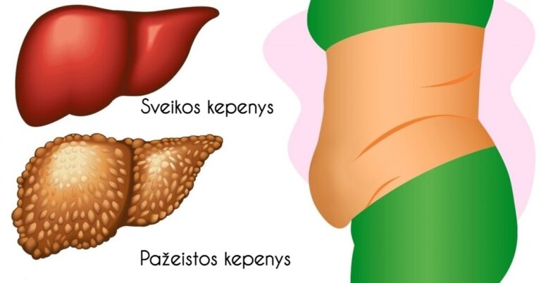 6 ženklai, rodantys, kad jūsų kepenims nedelsiant reikia valymo