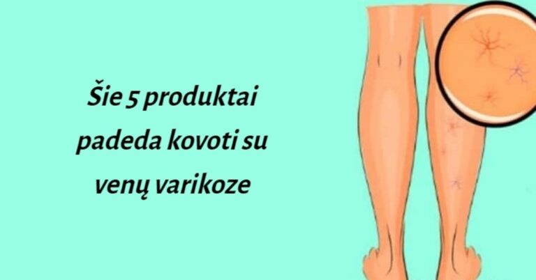 5 produktai, padedantys kovoti su venų varikoze